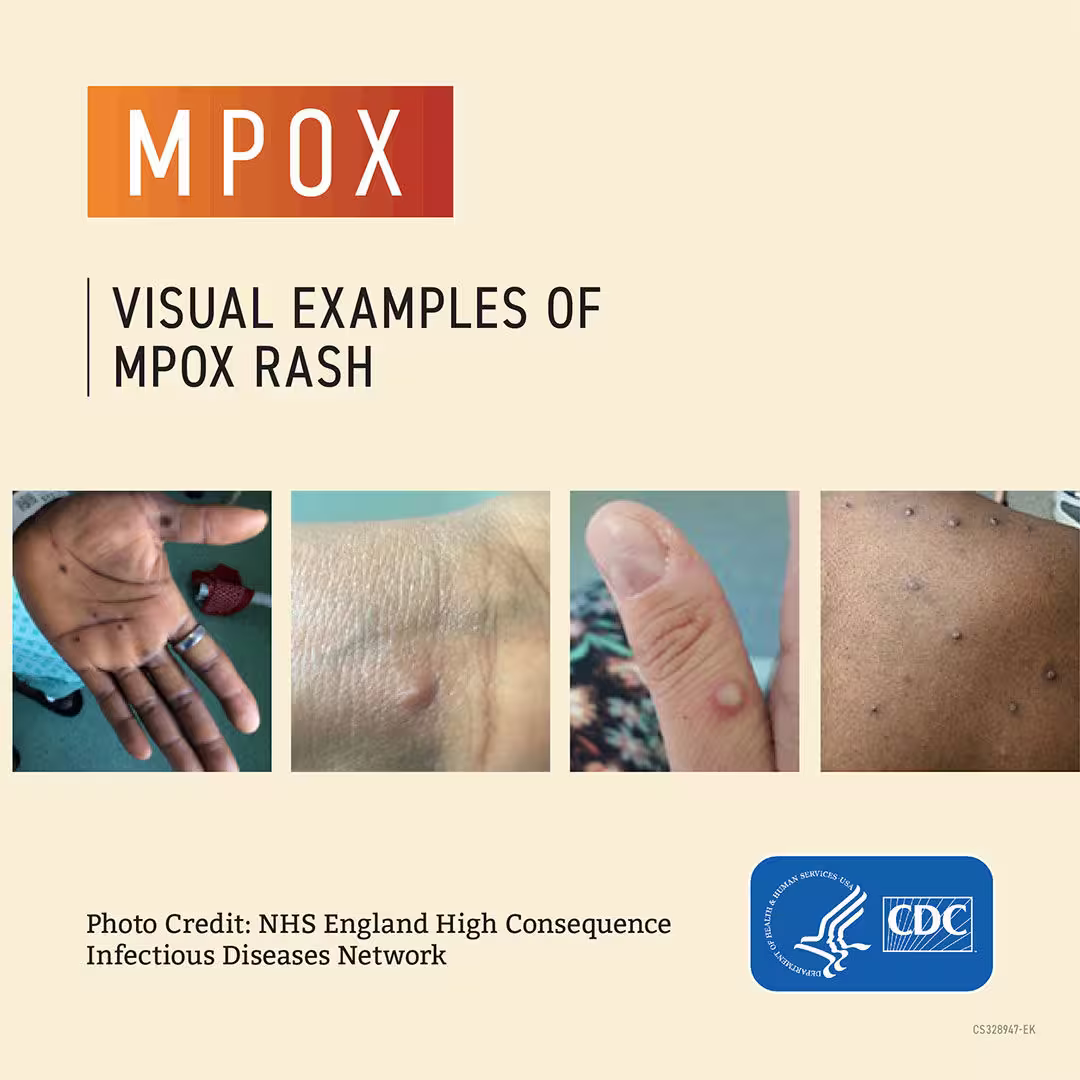 Le mpox n’est plus une urgence de santé internationale